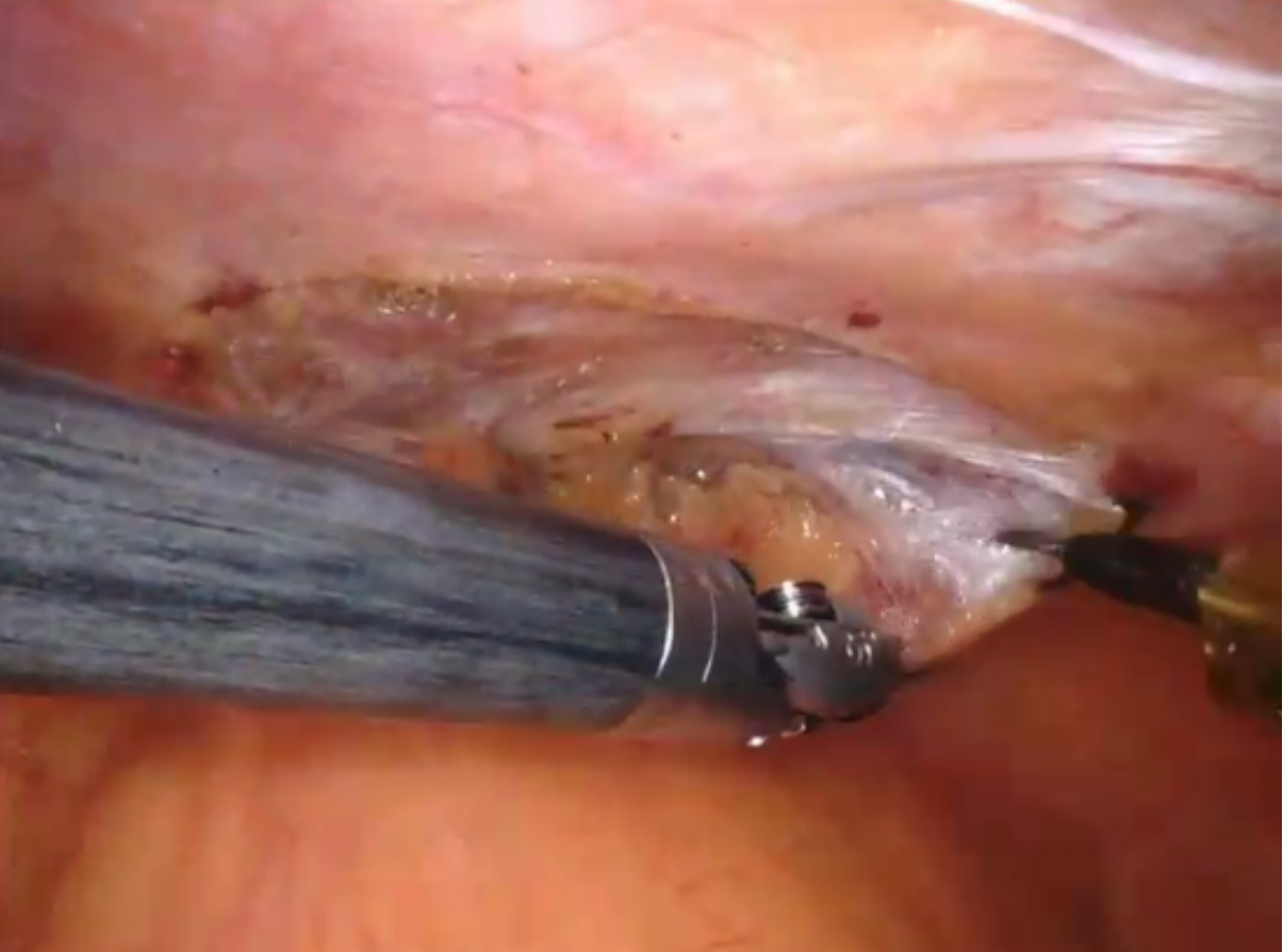 Revascularização Coronária Híbrida com Robótica